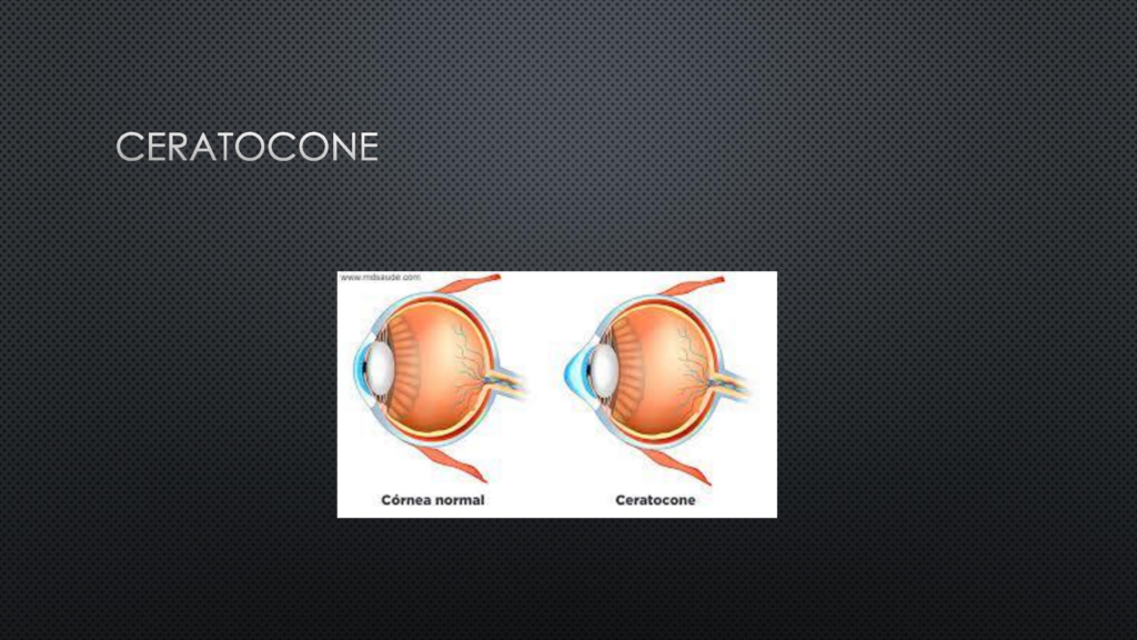 Ceratocone: Uma doença ocular que merece atenção